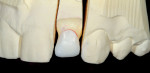 Figure 5  Zirconia coping tried on the model for fit check.