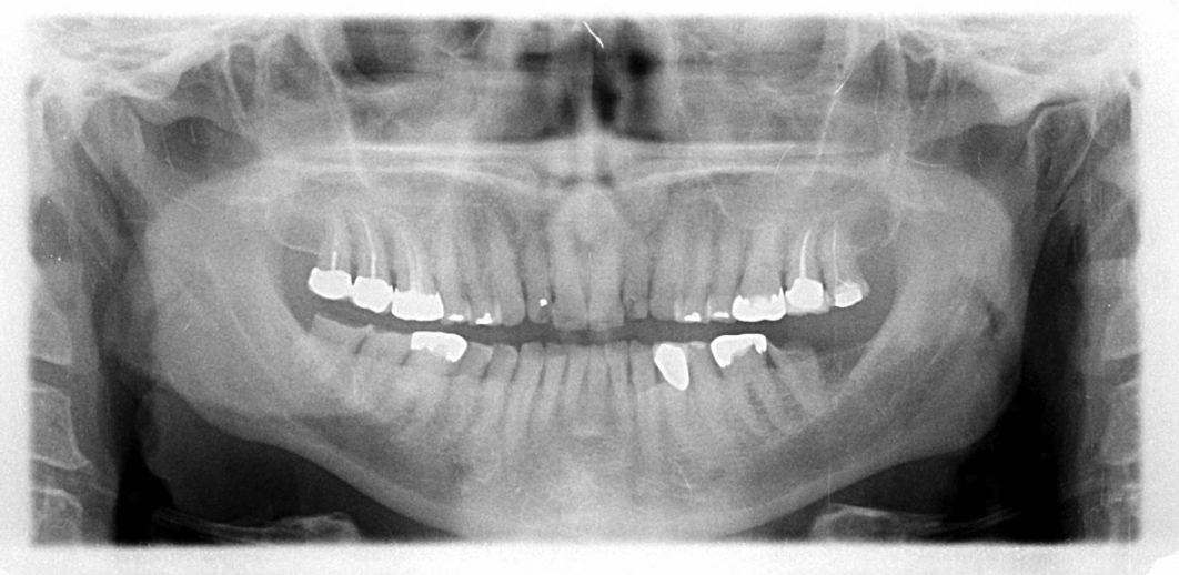 Innovative Staged Treatment of a Worn Dentition | April 2023 | Inside ...