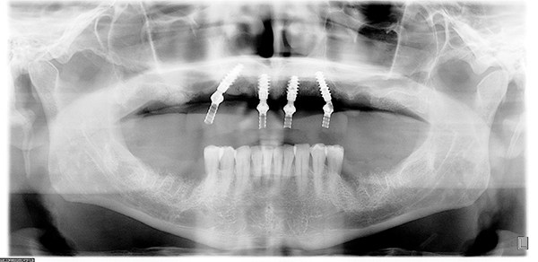 Nexus Scan Gauges and a validated intraoral scanner is all you need to  digitize your full-arch restoration workflow. When this data is…