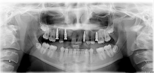 nobel biocare x ray