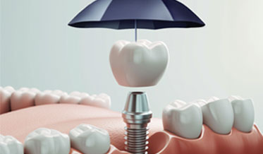 How to Preserve, Protect, and Defend Dental Implants