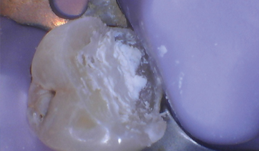 Vital Pulp Therapy: Managing Deep Caries in the Permanent Dentition Vital