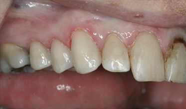 Simplifying Quadrant Dentistry Using a Single-Shade Composite