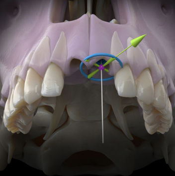 Dynamic Navigation for Dental Implants and Beyond—The Key to a Complete Digital Workflow