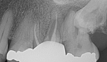 Incidental CBCT Findings: The Importance of Reading the Whole Image