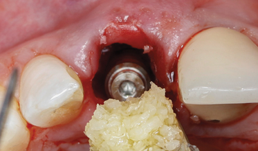 Selective Preservation of Tooth (SPOT): A Step-by-Step Protocol for a Precise, Reproducible, Socket-Shield Technique