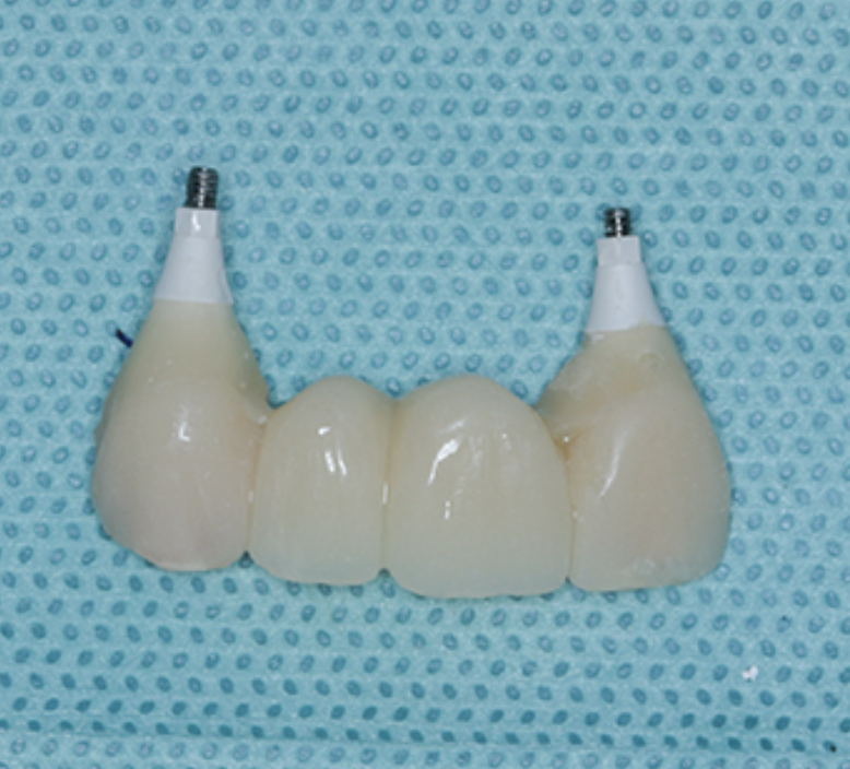 Reconstruction of Sockets and Associated Maxillary Ridge Defect Using Suture Tenting, Synthetic Bone Graft, and Unique Macro Morphology Implants With an Immediately Loaded Provisional Bridge