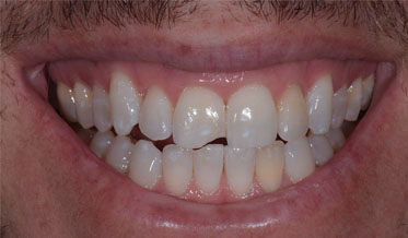 Composite Bonding in the Esthetic Zone