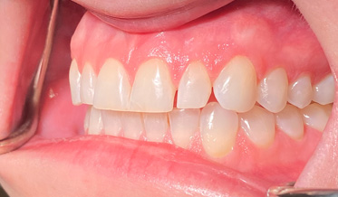 Placing Strong Class V Restorations Without Esthetic Compromise