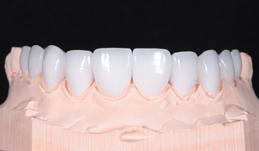 A Systematic Method for a Full-Mouth Rehabilitation of a Dentition With Extensive Overjet and Occlusal Dysfunction