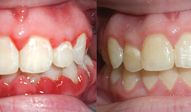 Effectiveness of Oral Rinse as an Adjunct to Toothbrushing: A 6-Week Clinical Trial Management of Plaque and Gingivitis With Daily Oral Rinsing