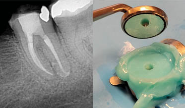 Single-Visit, Root Canal Re-treatment Using Advanced Technology