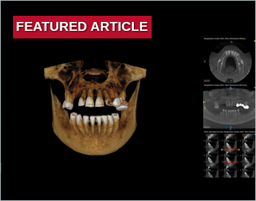 Digital Full-Arch Maxillary Rehabilitation