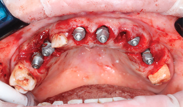 Digital Full-Arch Maxillary Rehabilitation