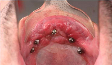 The Importance of Multidisciplinary Treatment Planning: Revision Treatment for Maxillary and Mandibular Arches Following Catastrophic Failure of Initial Implant Reconstruction