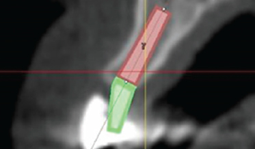 Position, Angulation, and Sink Depth: Aspects of Therapy Used to Avoid and Modify Suboptimal Implant Placement