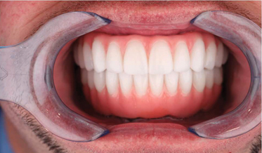 The Importance of Multidisciplinary Treatment Planning: Revision Treatment for Maxillary and Mandibular Arches Following Catastrophic Failure of Initial Implant Reconstruction