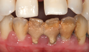 Diagnosis and Nonsurgical Treatment of Periodontitis: Pragmatic Utilization of Contemporary Knowledge