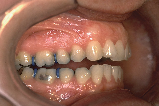 establishing-ideal-occlusion-to-achieve-esthetic-and-functional