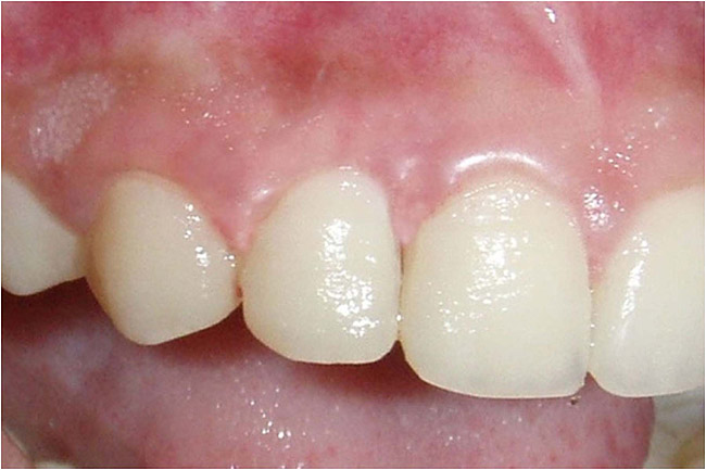 ossifying fibroma oral