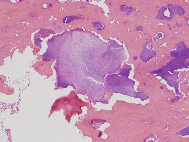 Osteonecrosis Of The Jaw Histology