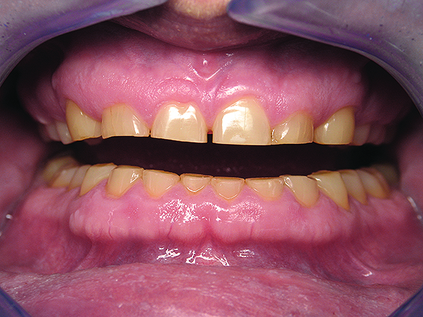 OCCLUSAL PROBLEMS