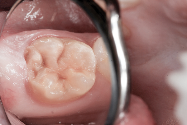 Decalcification In Baby Teeth