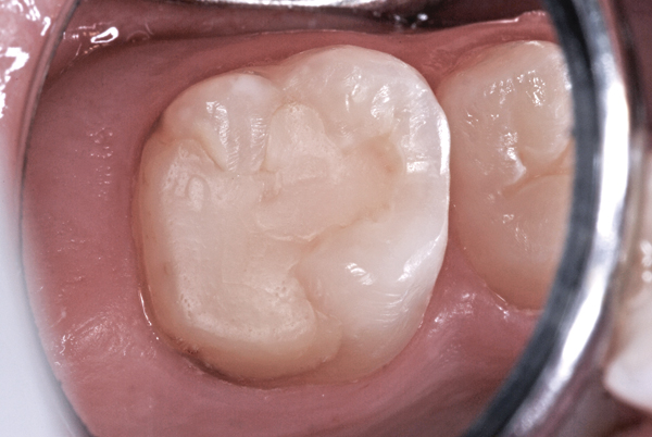 Enamel Hypocalcification