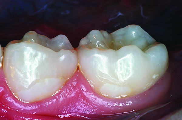 glass ionomers in dentistry