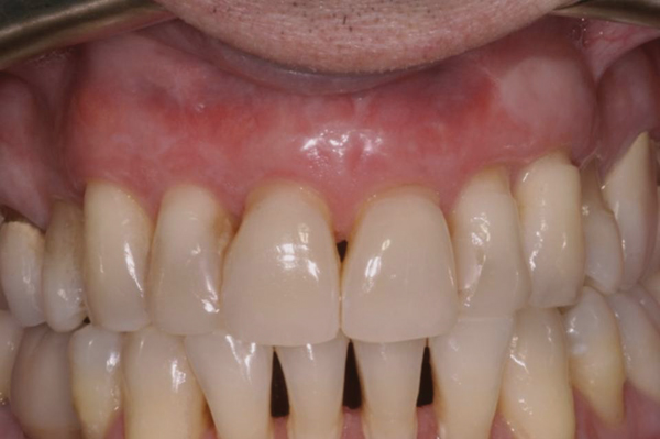 papillary gingiva