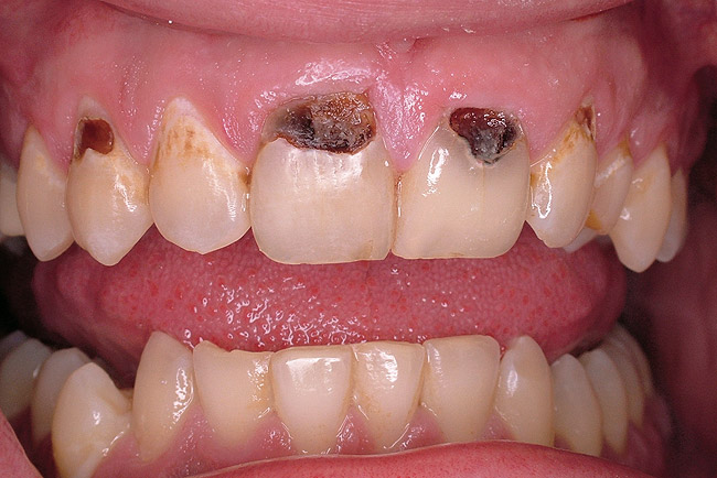 Cervical Caries - Treatment Options Based Upon Etiology of the Lesion ...