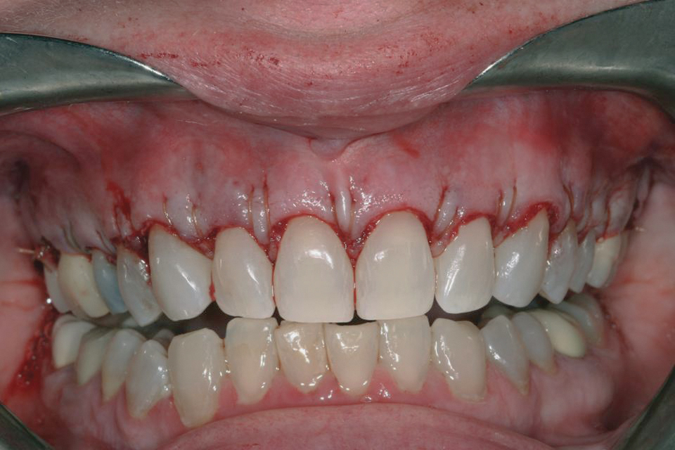 Cemento dental - EcuRed