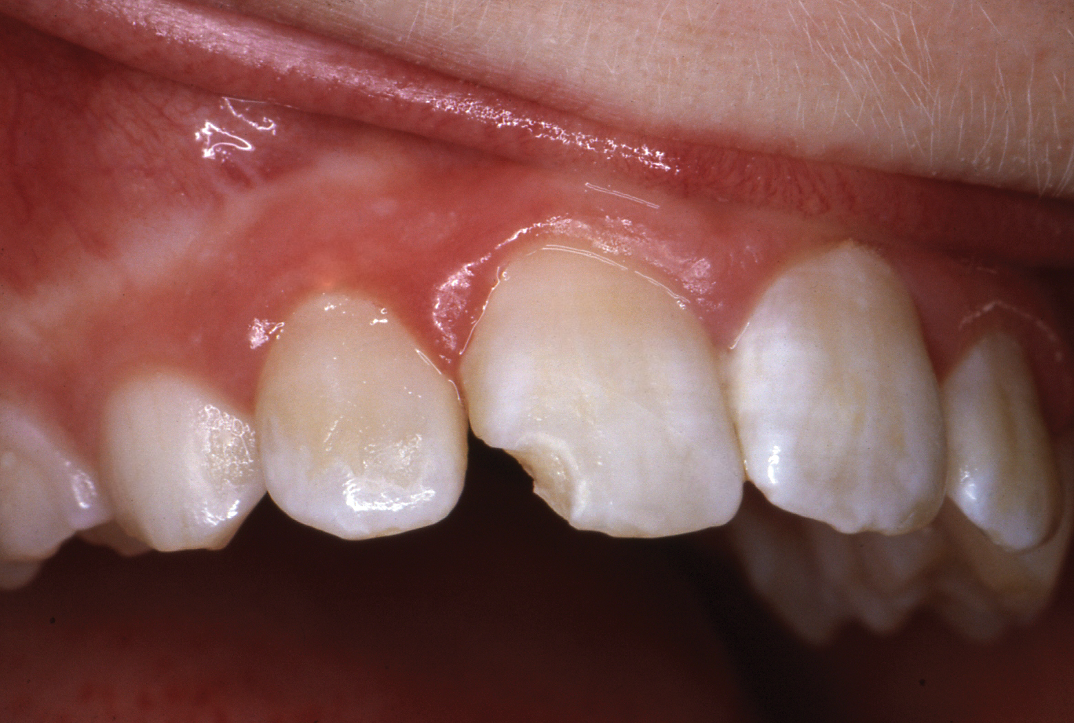 32 Year Follow up Of A Class IV Central Incisor Restoration Page 1 August 2016 Inside 