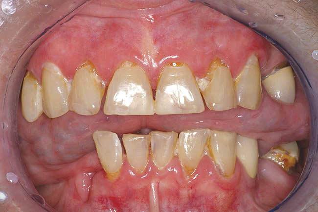 Xerostomia Caries