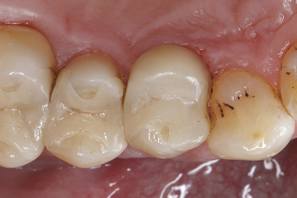 Case Study: Composite Front Teeth Repairs