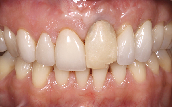 Definitive veneers and crowns prepared digitally using prosthetic