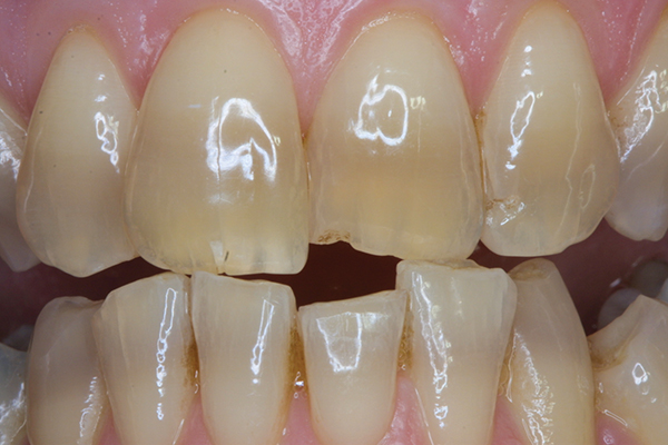 Bleaching Tetracycline Stained Teeth Volume 14 Issue 1 Inside Dentistry