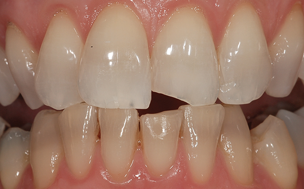 Bleaching Tetracycline Stained Teeth Volume 14 Issue 1 Inside Dentistry