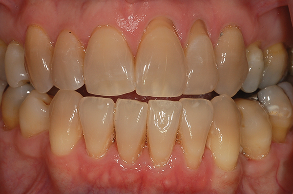 Bleaching Tetracycline Stained Teeth Volume 14 Issue 1 Inside Dentistry