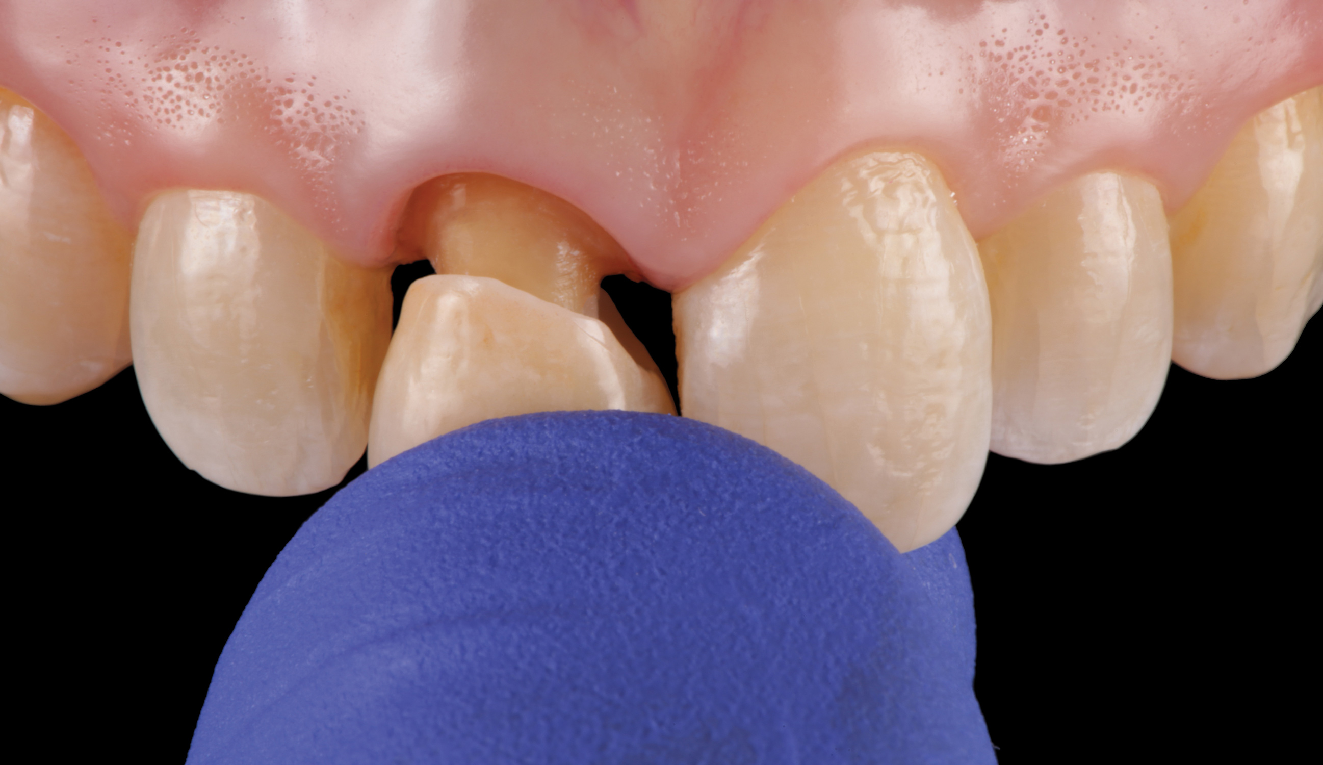 Zirconia Crowns Cementation