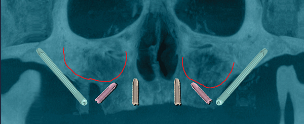 zygomatic arch implants