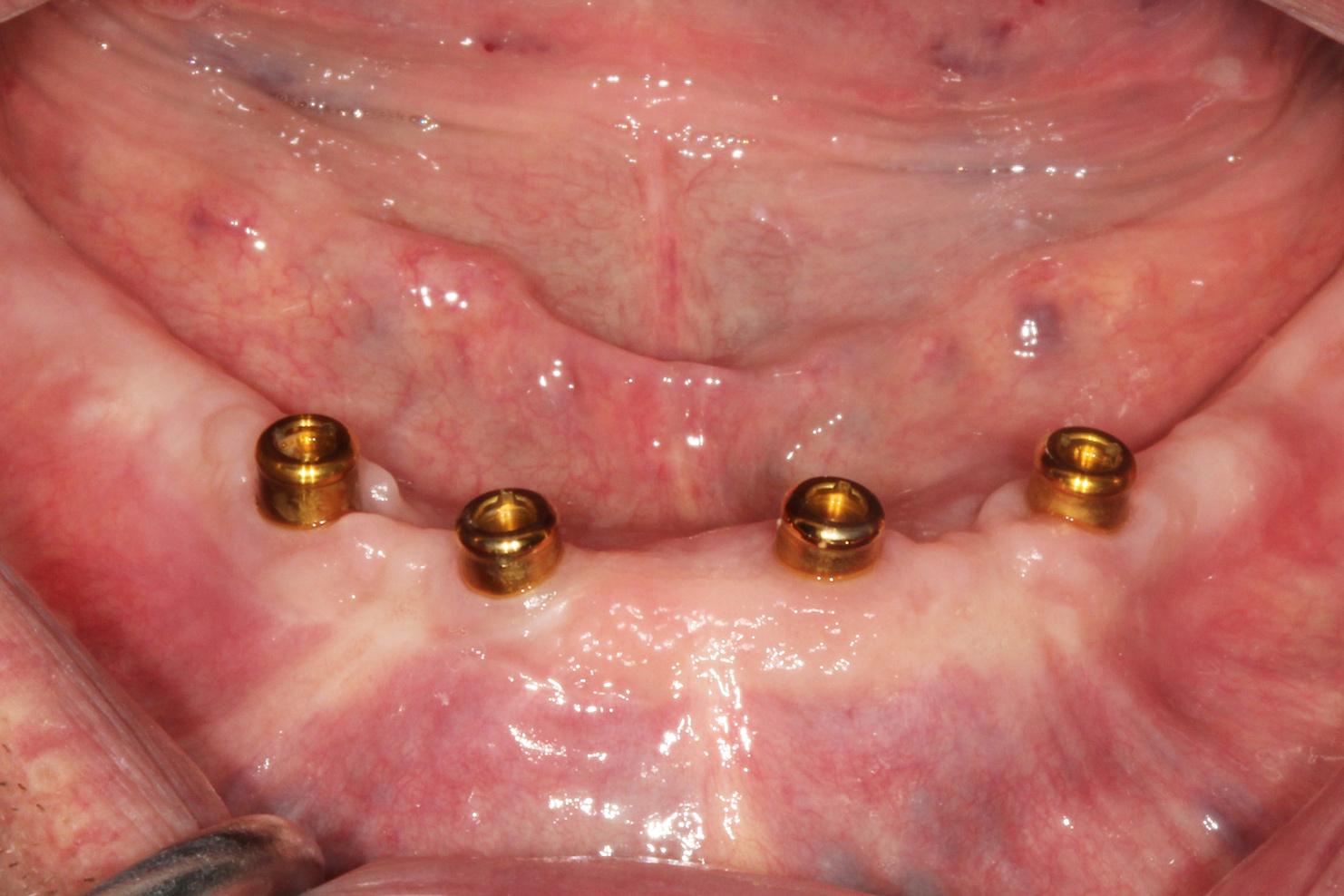 Attachment Selection for Implant-Supported Overdentures - Decisions in  Dentistry