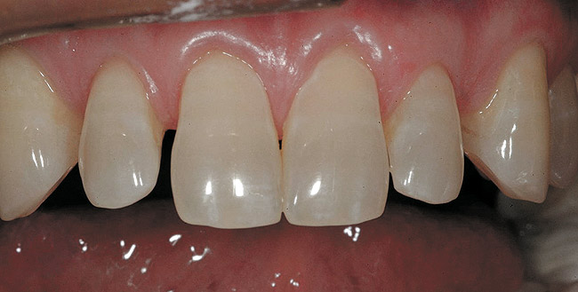 all ceramic crown preparation