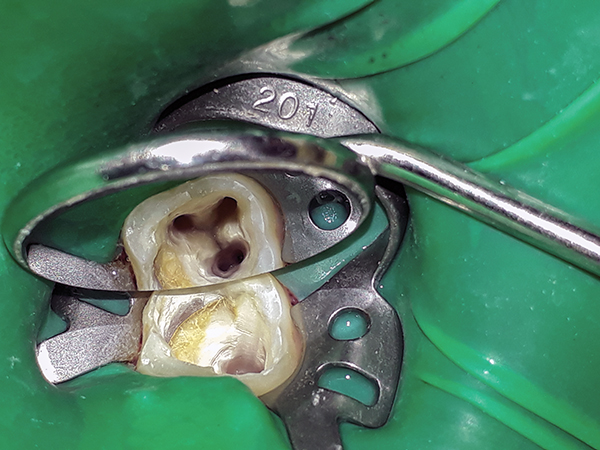 Unusual Upper Second Molar with 5 root canals - AbuMaizar Dental