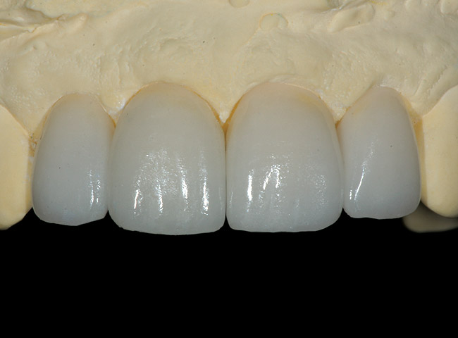 All Ceramic Crown Prep in 5 Minutes