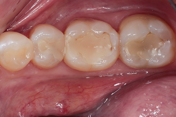 secondary caries