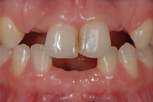 Resin Bonded Bridge: Minimally Invasive Option for Tooth Replacement - Shor  Dental