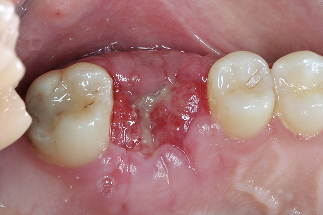 granulation tissue tooth extraction