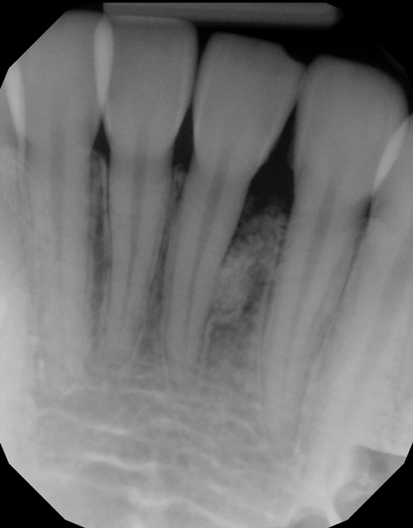 moderate periodontitis radiograph