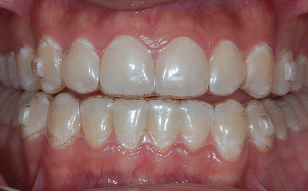 brace teeth white